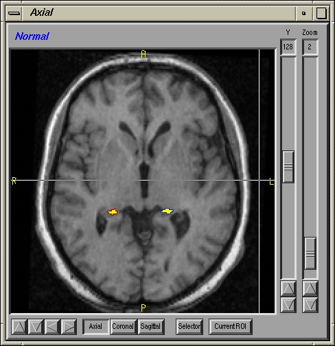 Image T1_11067_hippocampus