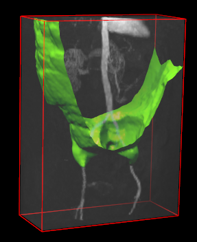 Image ffce-mra_abdo1_frontwave