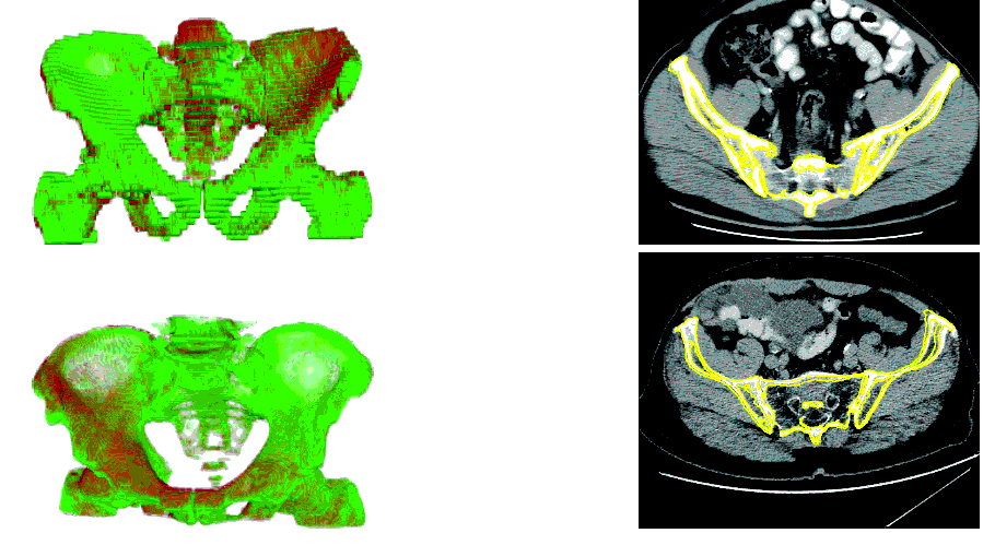 Pelvic CT